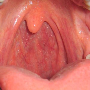 gola-infiammata